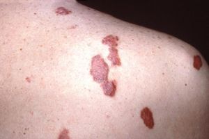 kaposi photo1