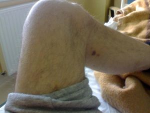 my Kaposi leg today