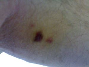 my Kaposi chest when in AIDS
