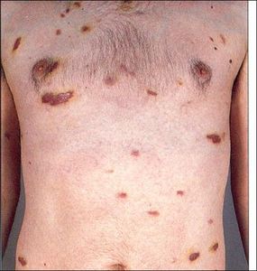kaposi sarcoma 5481