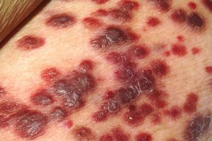 kaposi leg before treatment