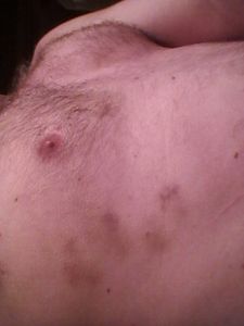 Bite marks 3