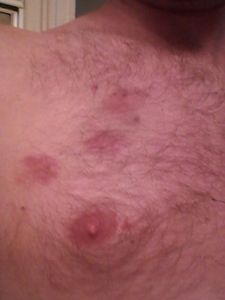 Bite marks 5