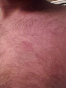 Bite marks 6