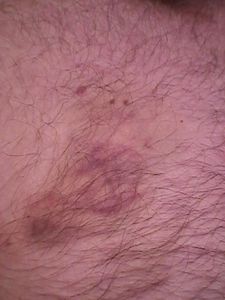 Bite marks 7