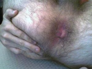 teenhole