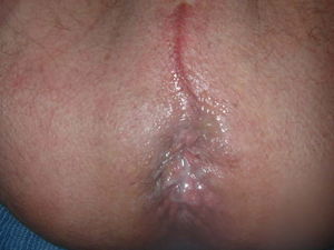 Leaking 1