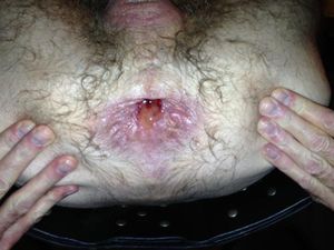 My ass after being slammed, bloodied, fucked and fisted.