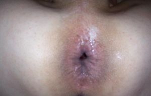 OpenHole