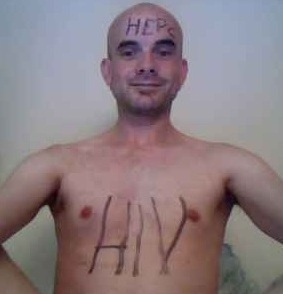HIV