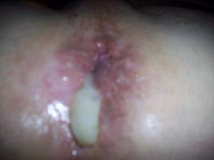 poz cum leak with syphilis from a fuckr with full blown AIDS met at the baths.
