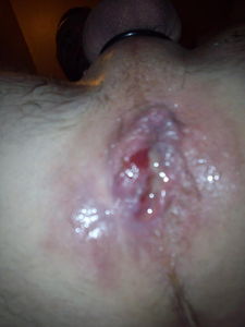 bloody anal wart with AIDS seed 2