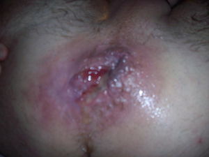 bloody anal wart with AIDS cum
