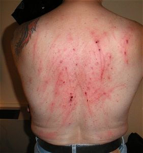 After a single-tailing