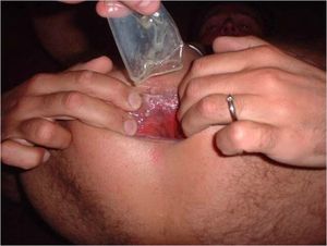 gay used condom