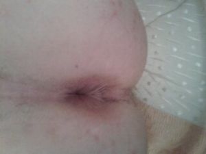 My stretched hole