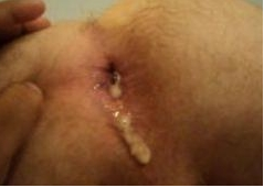 filled hole