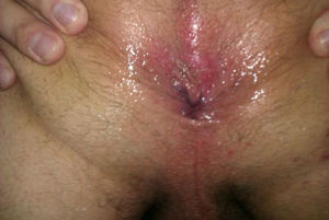 my open Asshole