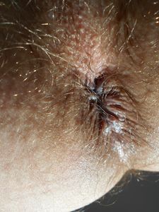 Ken's butthole   close Up 2015 11 03 [Chicago]