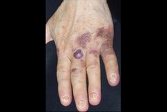 FCASCD_classic_kaposis_sarcoma_ecchymotic.jpg