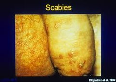 scabies.jpeg