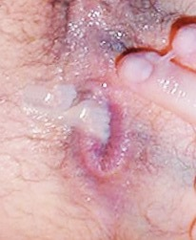 HL - Stretched and Oozing